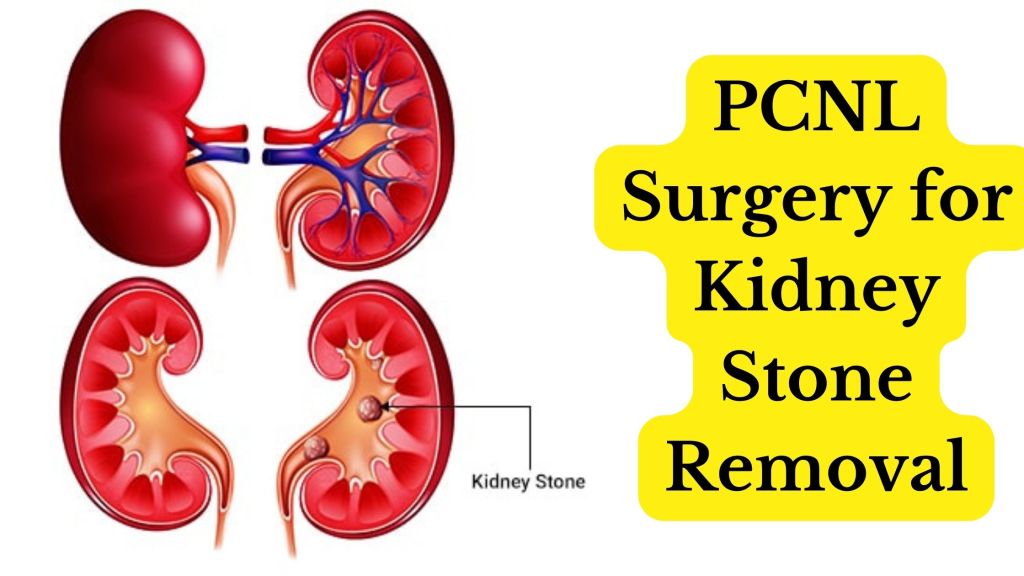 What is the role of diet in preventing kidney stones?