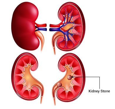 Kidney Stones: Symptoms, Causes & Treatment Options