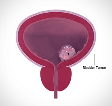 What Is The Most Common Surgery For Bladder Cancer?