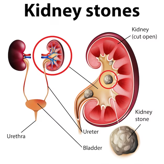 7 Important Facts About Kidney Stones Everyone Must Know